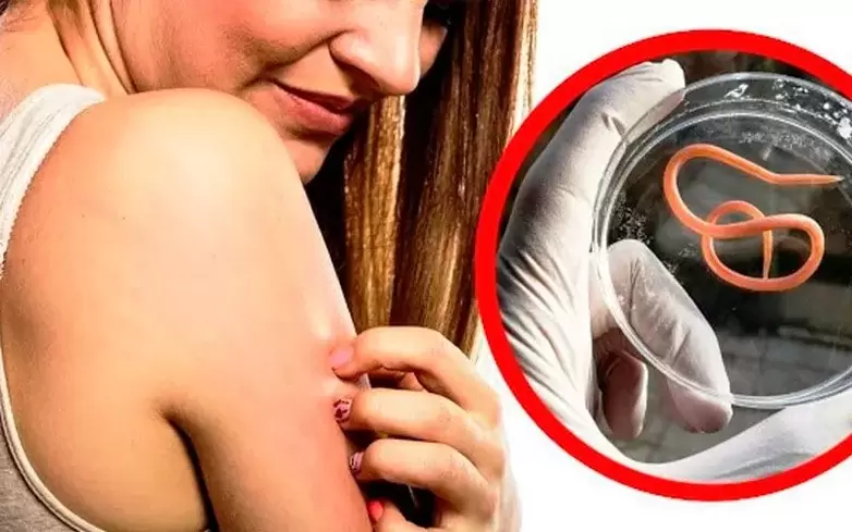 kehas parasiitidest põhjustatud sügelus ja ärritus