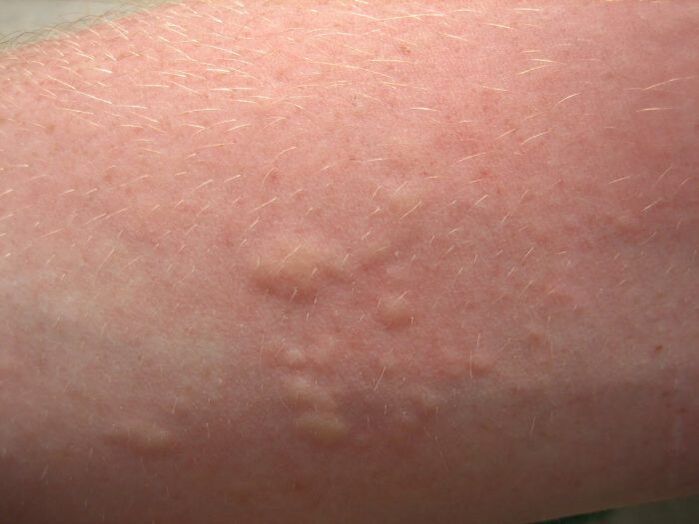 sügelevad allergilised nahalööbed võivad olla askariaasi sümptomid