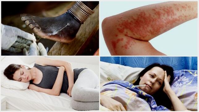 Subkutaanse parasiitide nakatumise tavalised sümptomid
